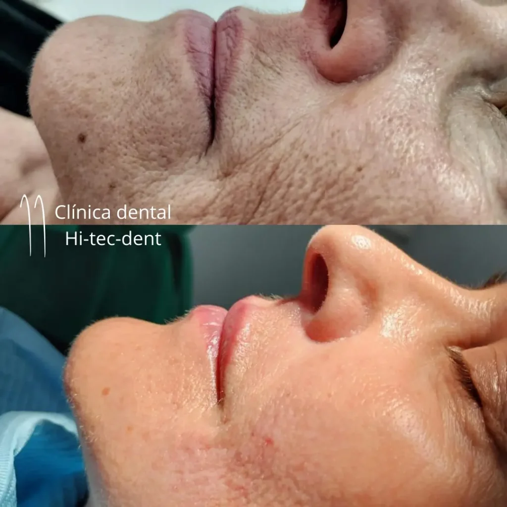Before and after, hyaluronic acid treatment